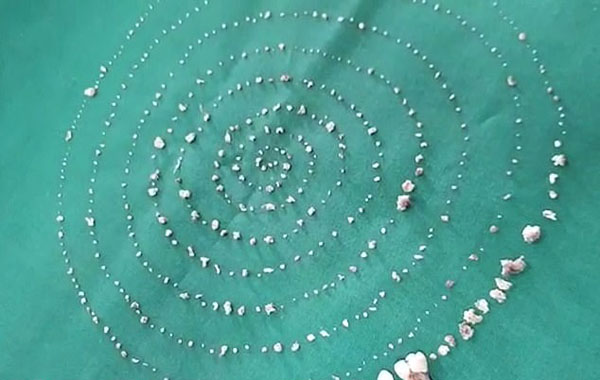 度一7岁男孩下巴肿胀 医生从其口中拔出526颗