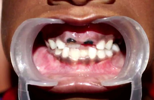 印度一7岁男孩下巴肿胀 医生从其口中拔出526颗牙齿 